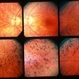 Retinitis Pigmentosa